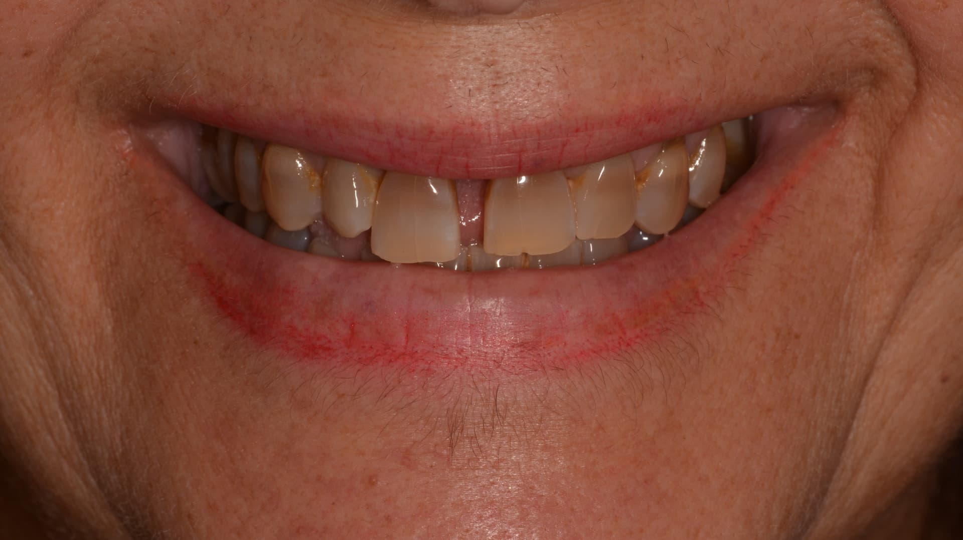 Antes del tratamiento