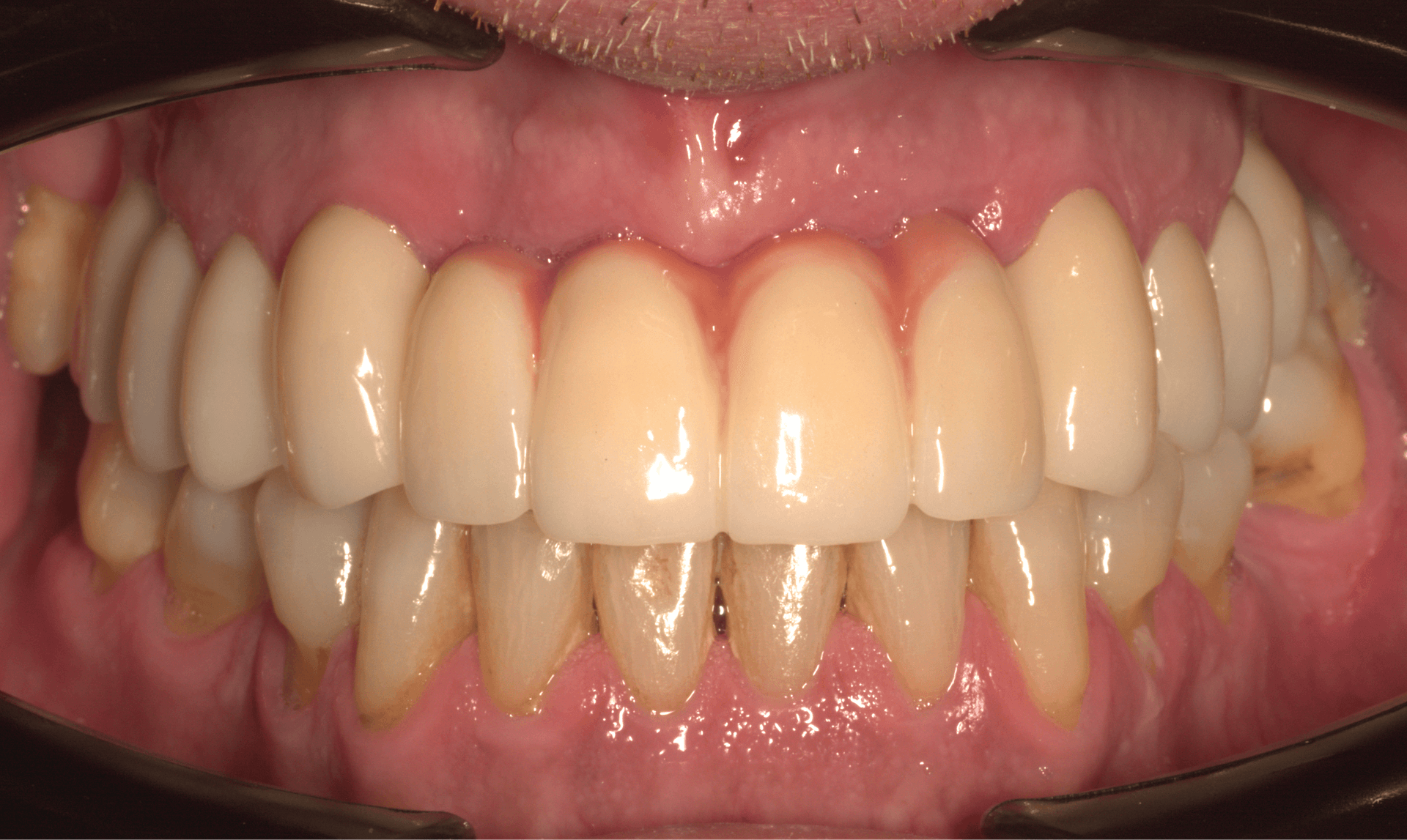 Después del tratamiento