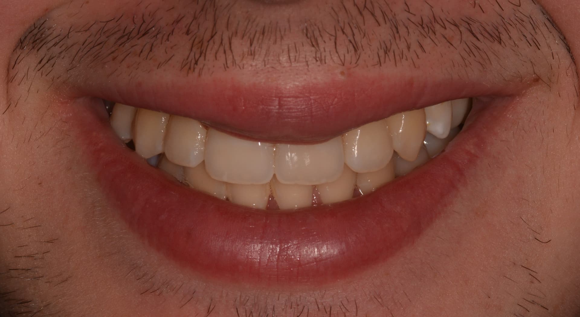 Después del tratamiento