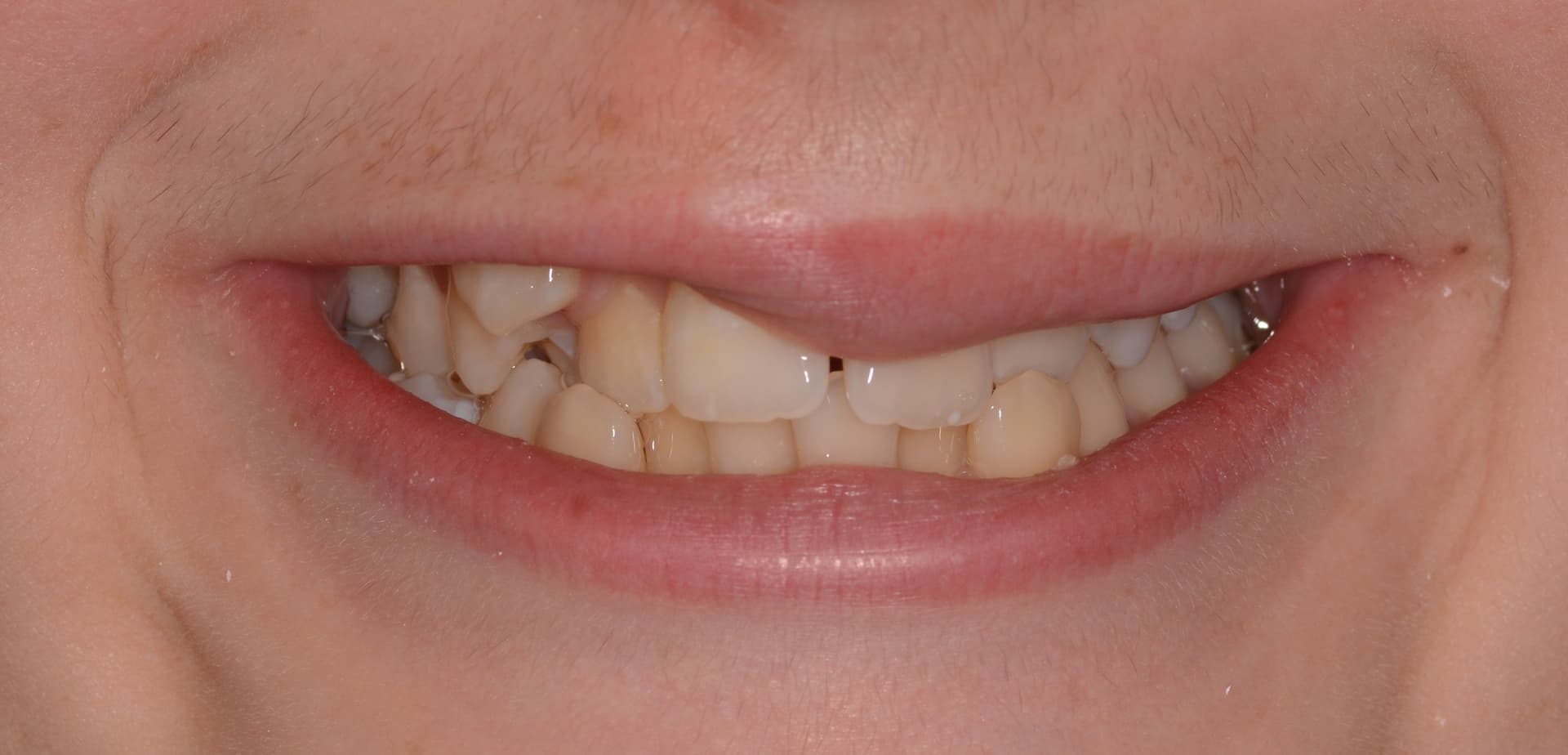 Antes del tratamiento