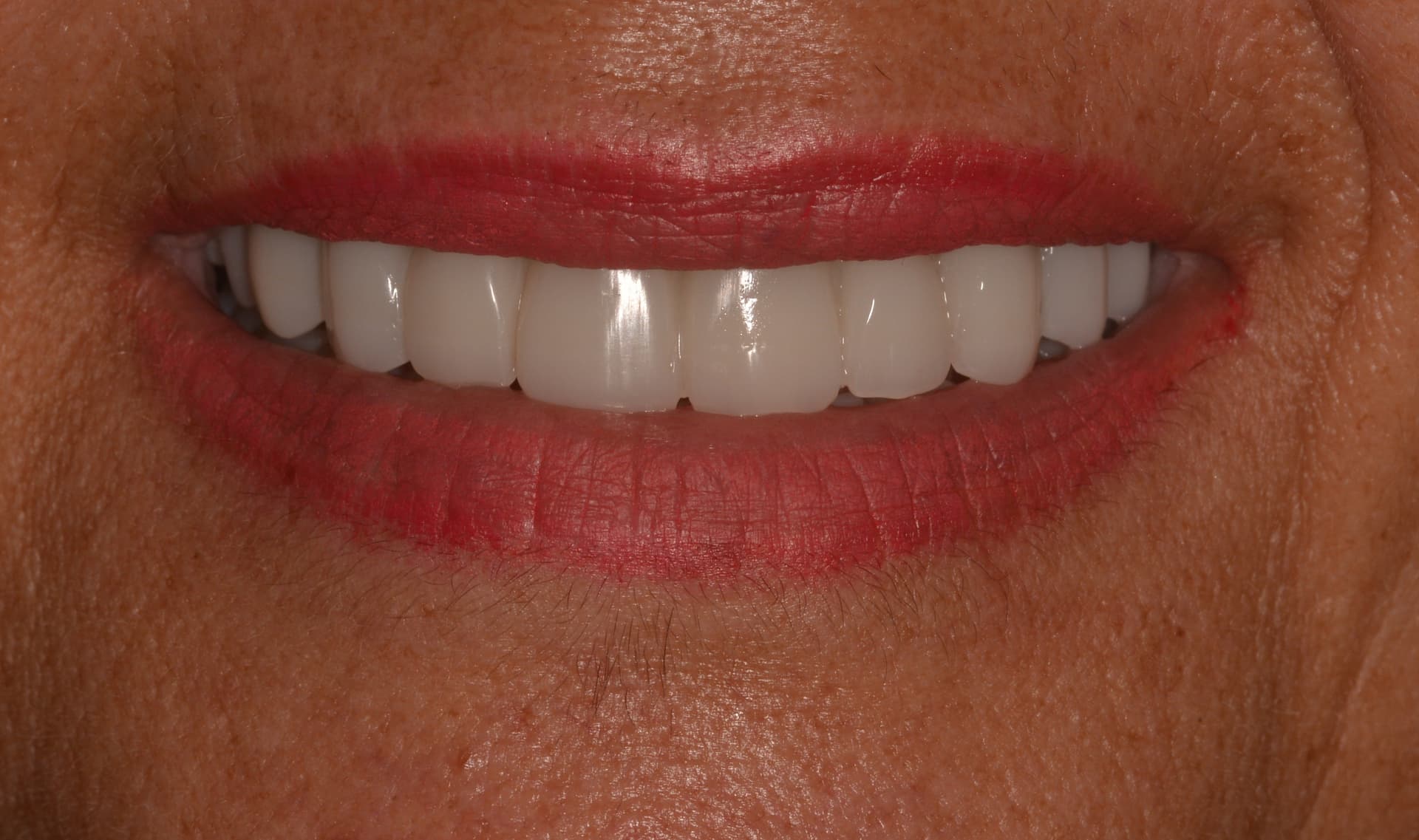 Después del tratamiento