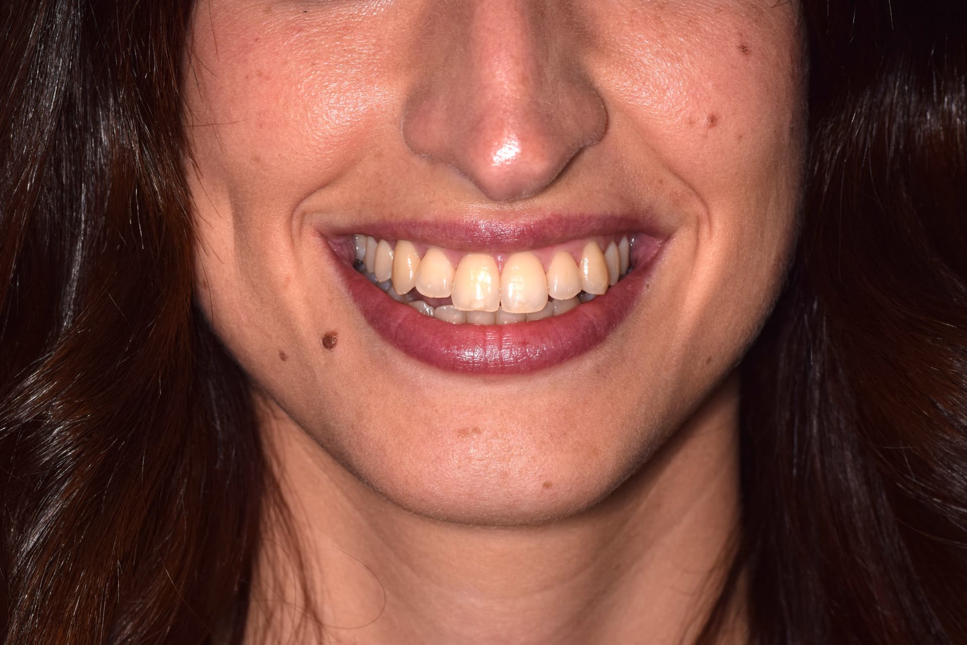 Antes del tratamiento