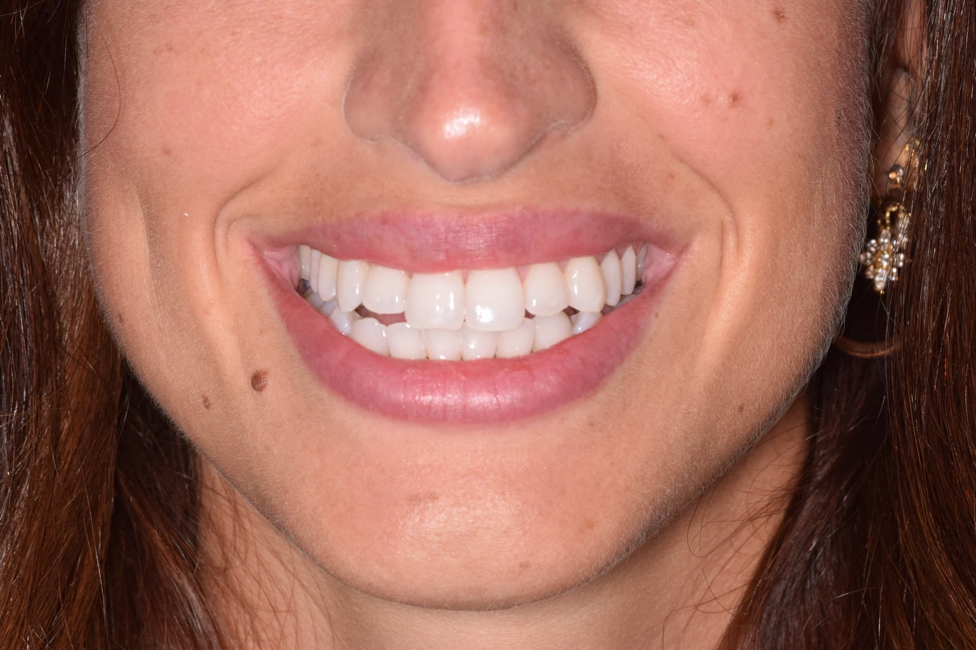 Después del tratamiento