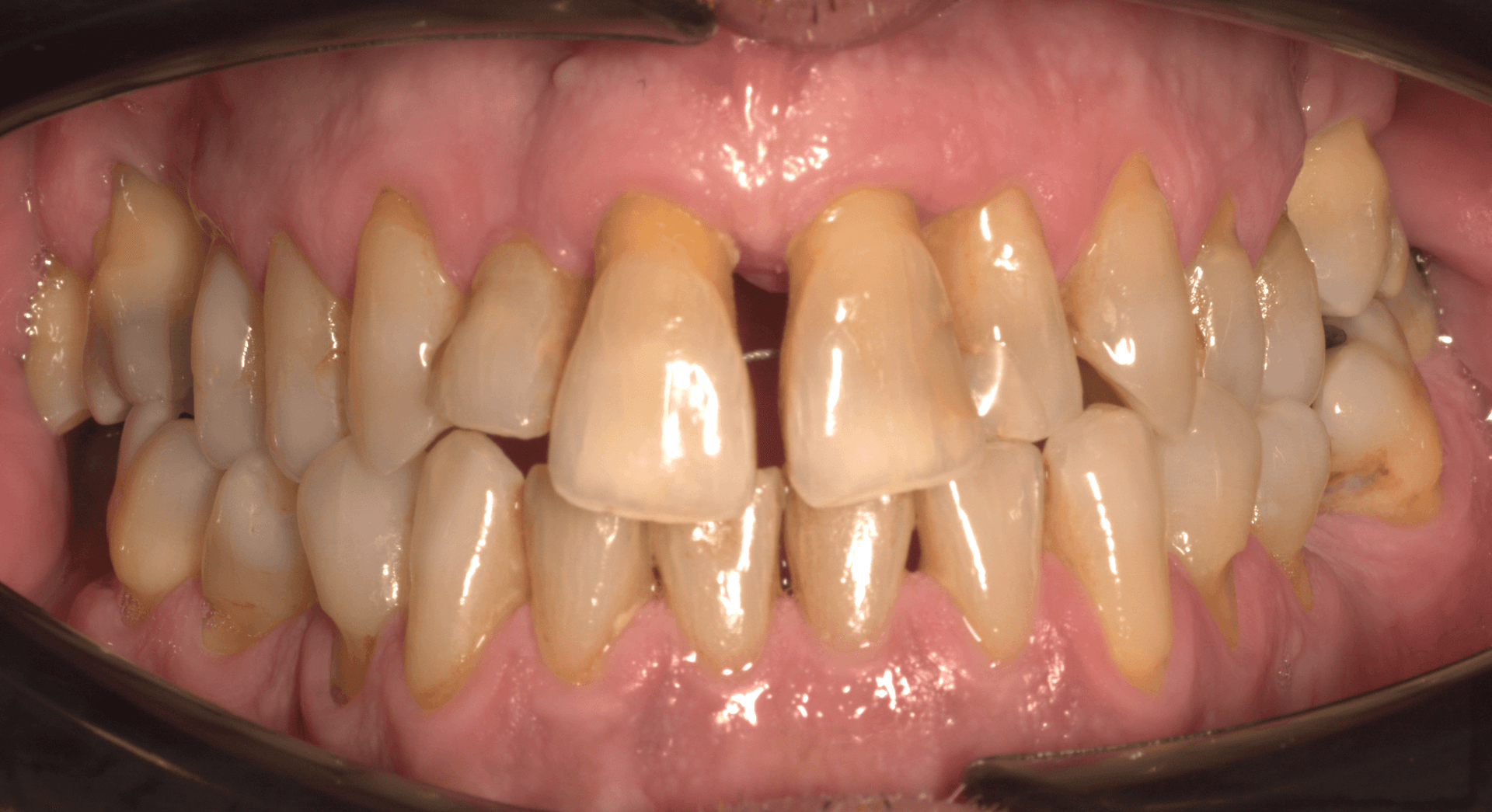 Antes del tratamiento