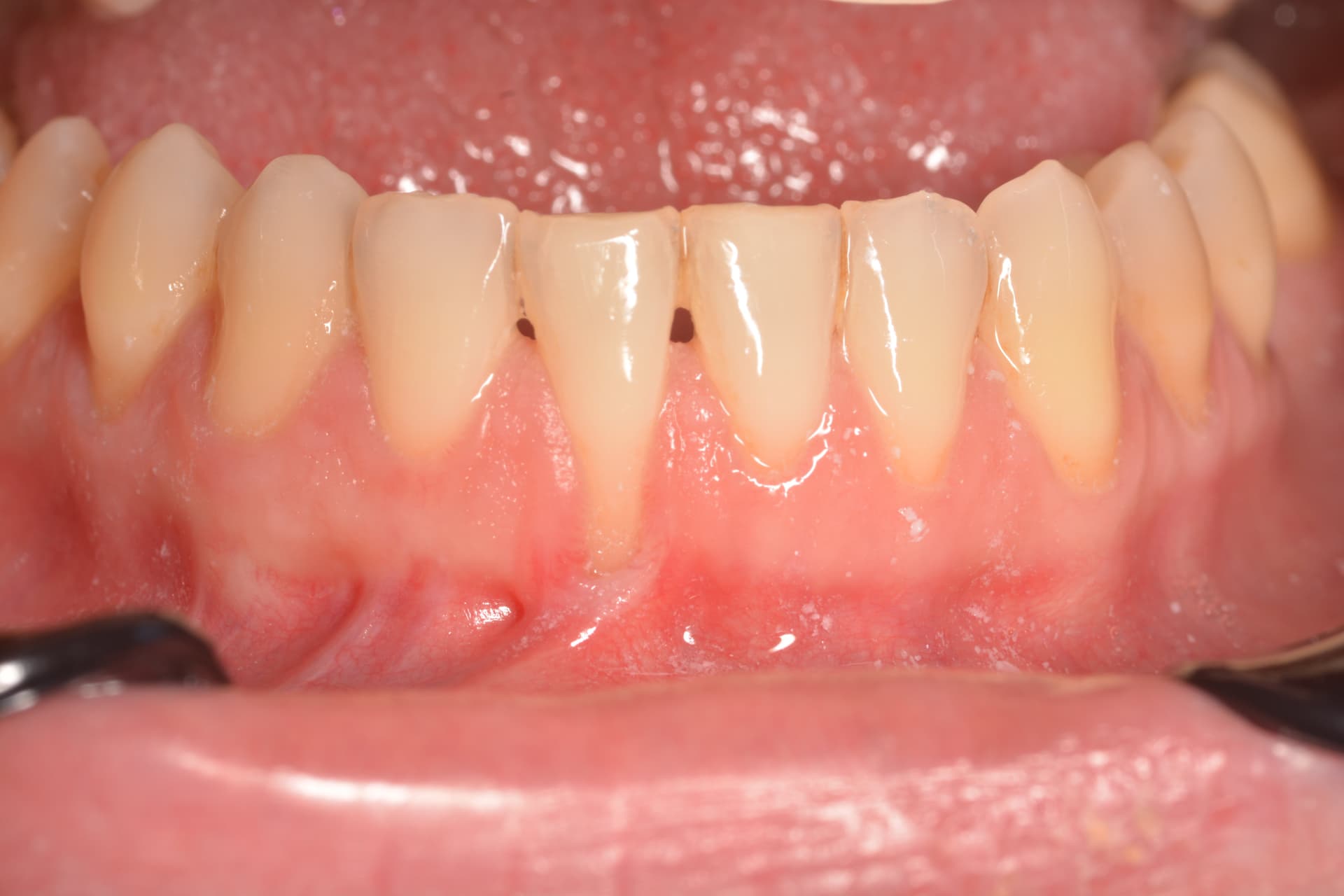 Antes del tratamiento