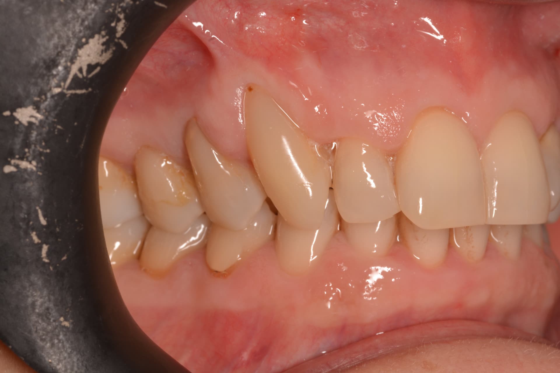 Antes del tratamiento