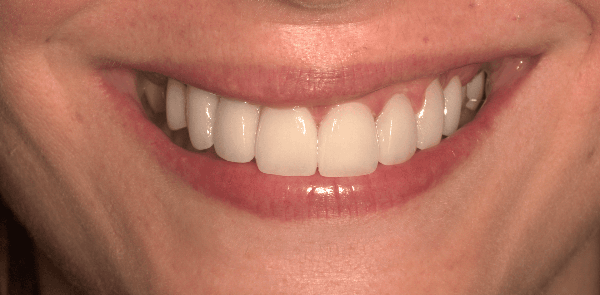 Después del tratamiento