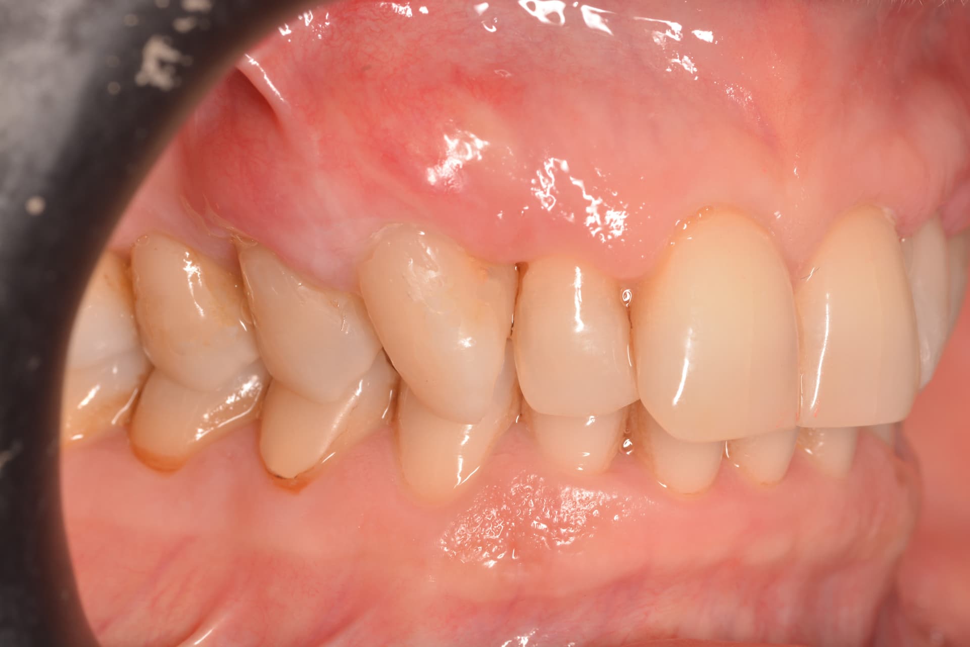 Después del tratamiento