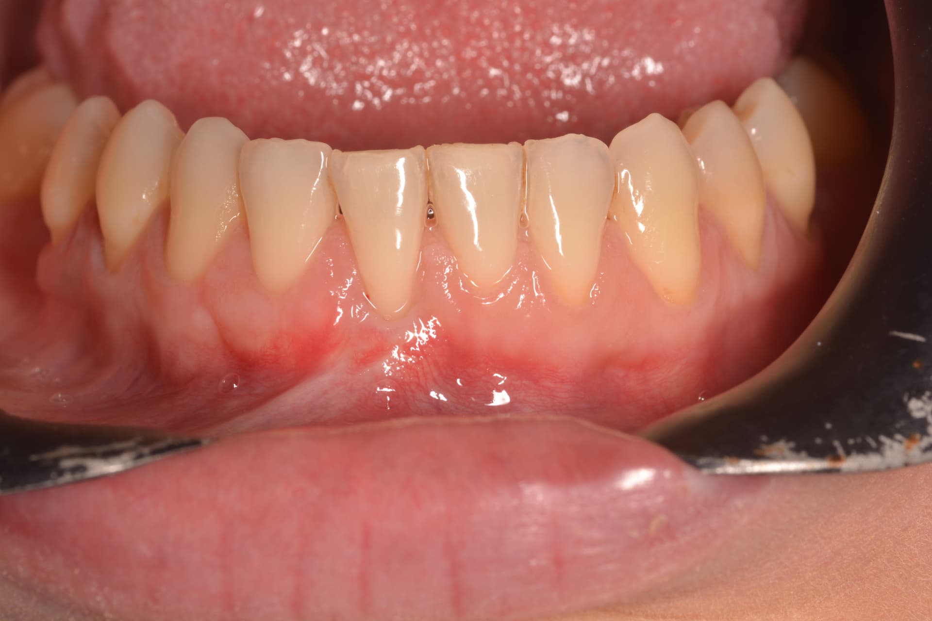 Después del tratamiento