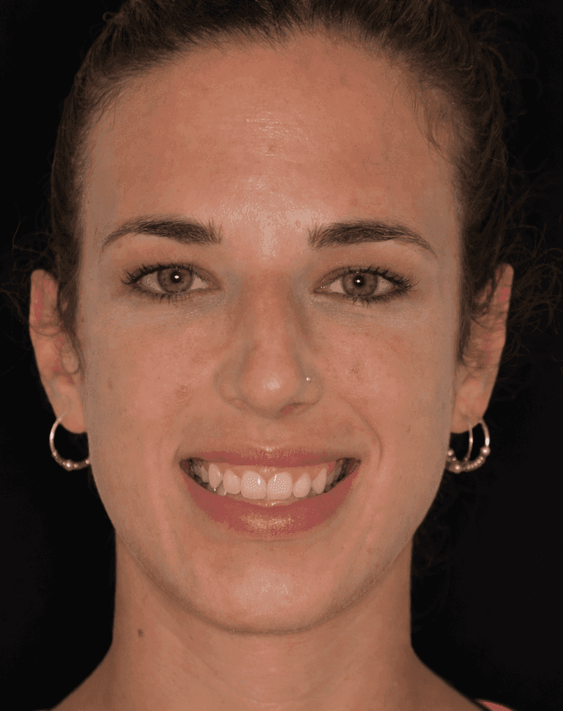 Antes del tratamiento